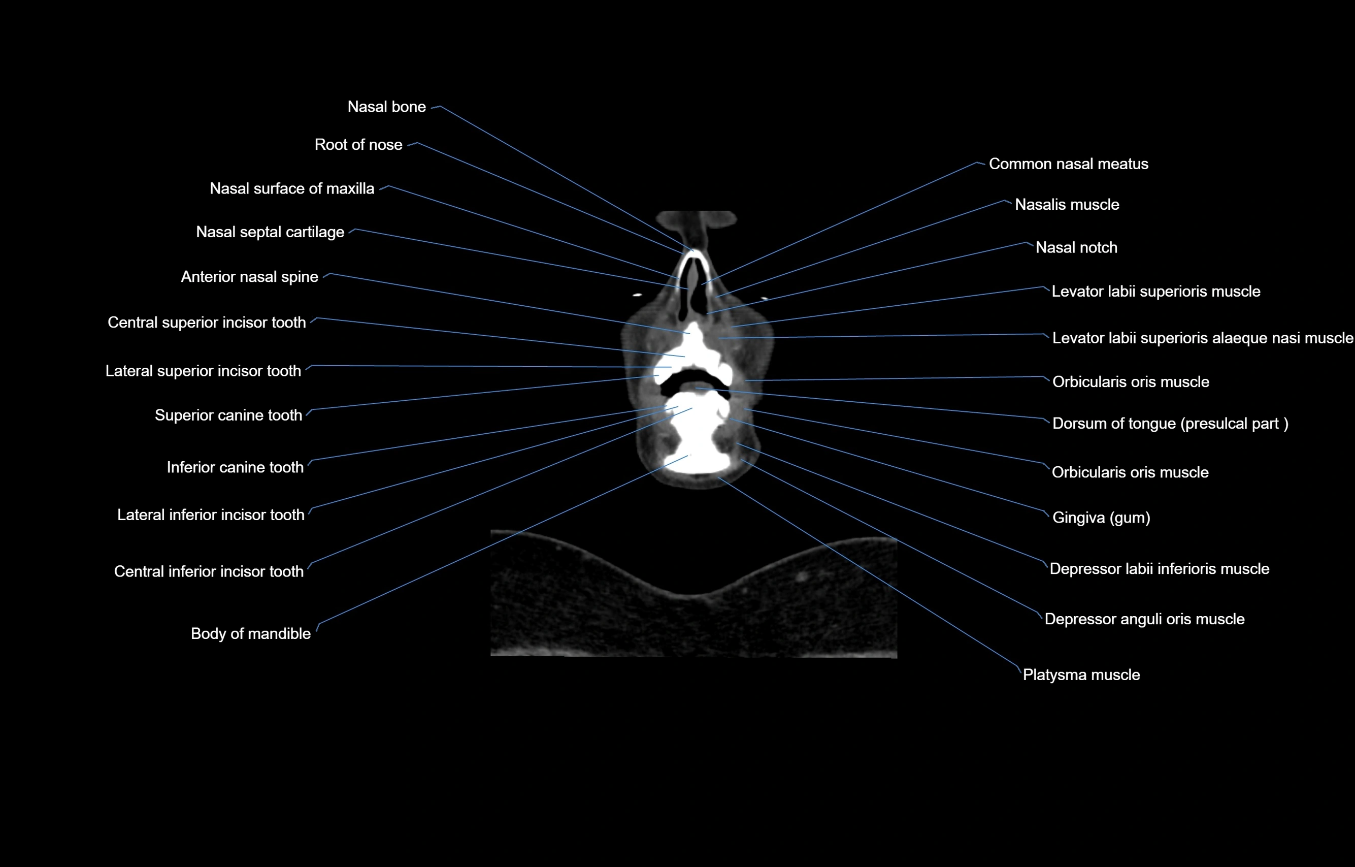 CT Neck coronal  cross sectional anatomy labelled 3D  radiology  image-00008.webp